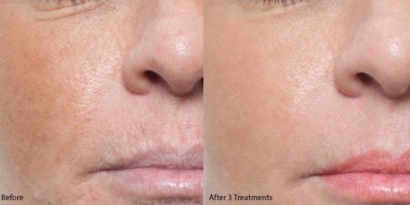 Microneedling before and after results 