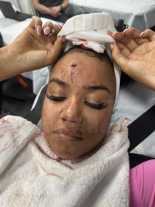 A photo of Bryhana Monegain at the hospital showing the laceration on her forehead after being assaulted by 50 cent.