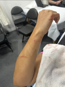 A photo of Bryhana Monegain at the hospital showing the lacerations on her forearm after being assaulted by 50 cent.