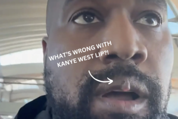 What's Wrong With Kanye West's Lip?