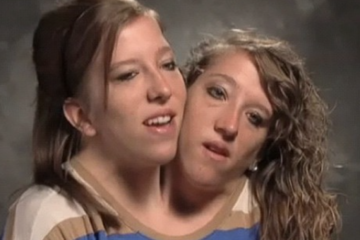 How Did Conjoined Twins Get Married
