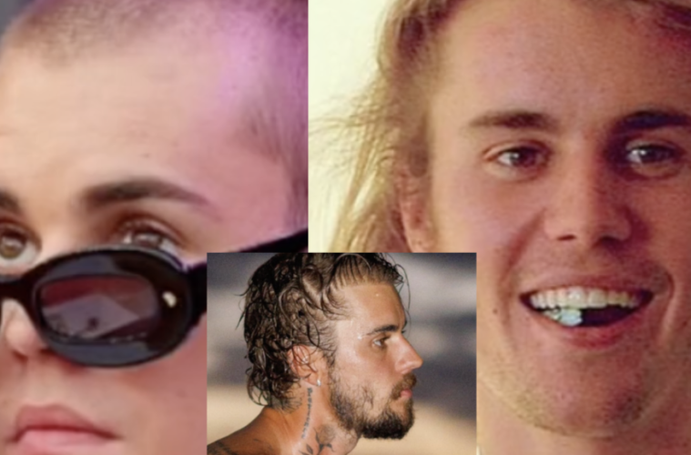 Did Justin Bieber Get A Hair Transplant?