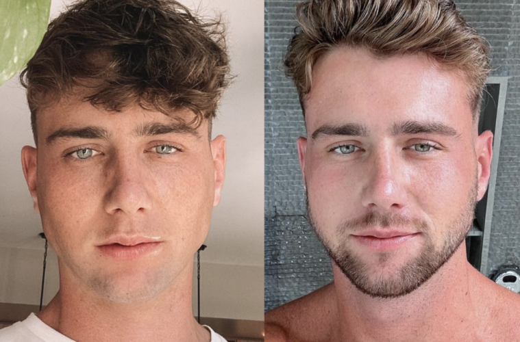 Harry Jowsey Before And After Plastic Surgery Rumors Addressed