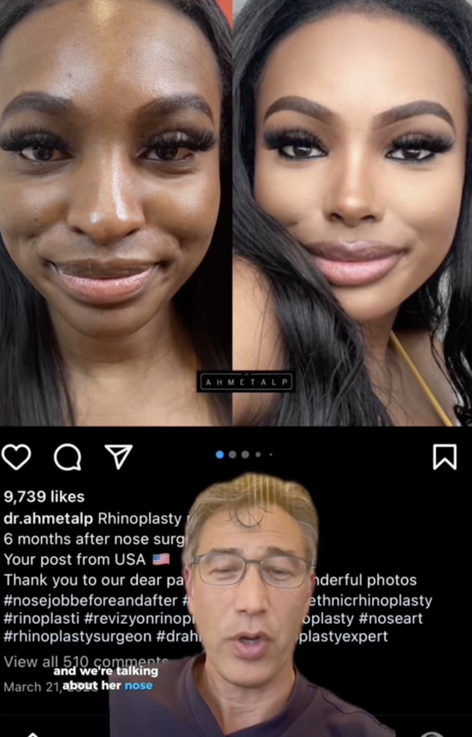 JaNa Love Island Nose Job Before Surgery Photos Exposed