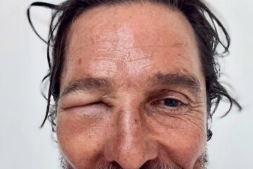 Matthew McConaughey Bee Sting Swollen Eye