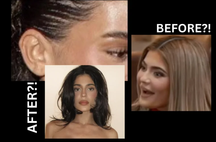 Kylie Jenner Facelift Proof?