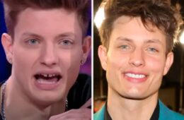 Matt Rife’s Smile Transformation