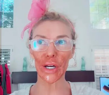 Brandi Glanville Shocks Fans with Facial Burns After DIY Skin Treatment Gone Wrong