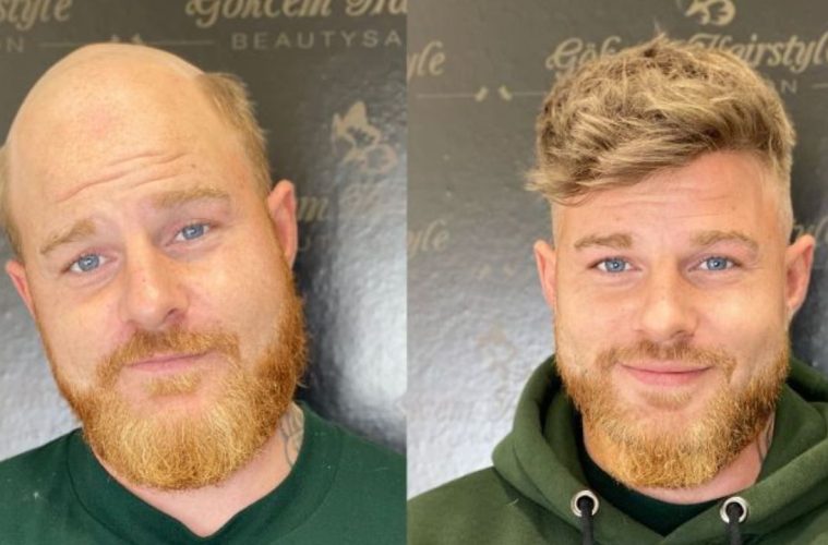 hair system cost: before and after wearing a hair system