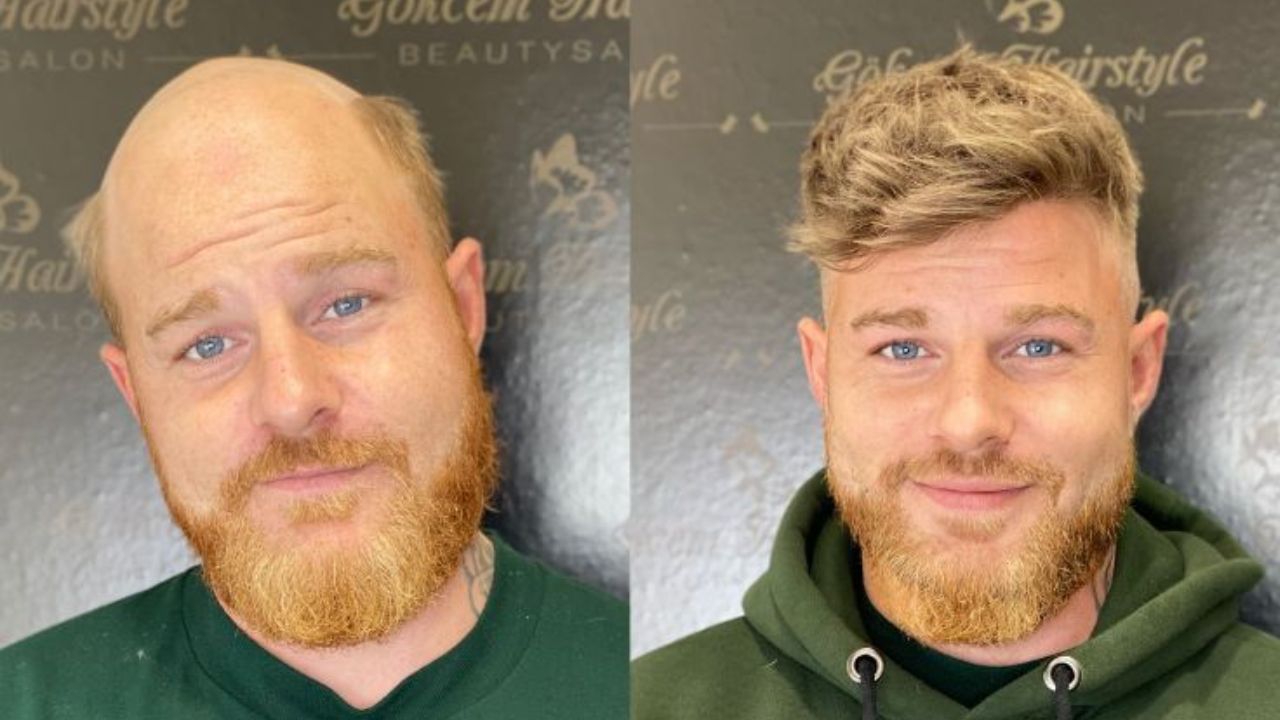 What You’ll Actually Pay for Hair Systems and a Fresh Look