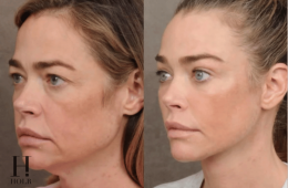 Denise Richards’ surgeon Dr. Ben Talei shares before-and-after facial surgery photos