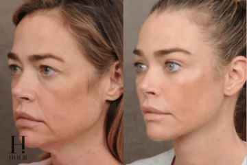 Denise Richards’ surgeon Dr. Ben Talei shares before-and-after facial surgery photos