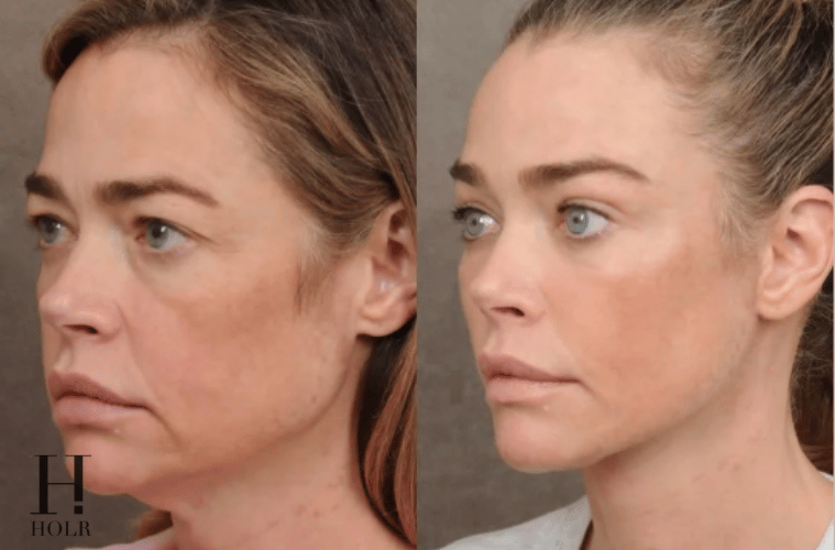 Denise Richards’ surgeon Dr. Ben Talei shares before-and-after facial surgery photos