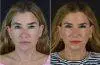 Drybar co-founder Alli Webb shares her facelift journey with before-and-after photos.