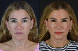 Drybar co-founder Alli Webb shares her facelift journey with before-and-after photos.
