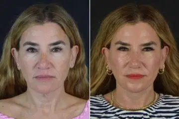 Drybar co-founder Alli Webb shares her facelift journey with before-and-after photos.