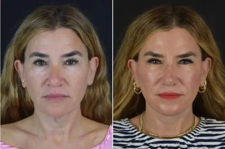 Drybar co-founder Alli Webb shares her facelift journey with before-and-after photos.